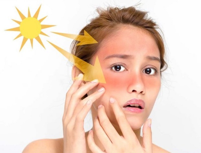 Cách khắc phục làn da bị cháy nắng sạm đen cấp tốc tại nhà