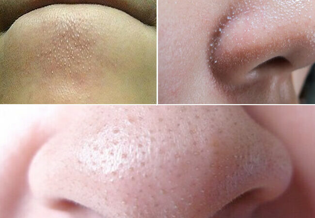 cách trị sợi bã nhờn trên mặt