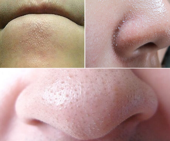 cách trị sợi bã nhờn trên mặt